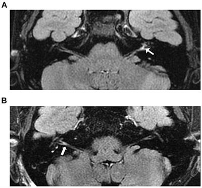 Clinical value of auditory nerve enhancement in idiopathic sudden sensorineural hearing loss: a retrospective study